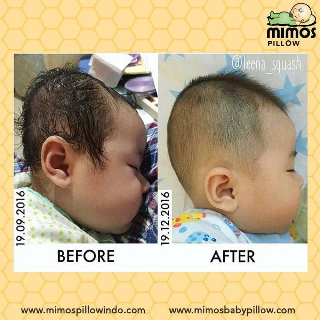 Almofada Mimos Para Prevenção E Tratamento De Plagiocefalia - Mimos Babytunes